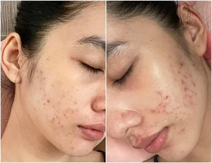 Social Media vs. Reality: The Truth Behind Flawless Beauty and Real Skin Struggles - image 2