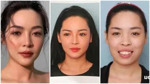 The Incredible Transformation of Vu Thanh Quynh: A Journey Through Plastic Surgery and Renewed Confidence - image 1