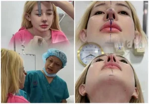 Ngân 98's Beauty Evolution: A Closer Look at Her 12 Rhinoplasty Procedures - image 5